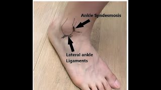 Injuries to the Distal Tibiofibular Syndesmosis [upl. by Demetrius541]