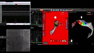 Great cardiac vein GCV VTAblation in coronarySinus EPStudy [upl. by Reggis]