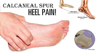 How to Get Rid of Heel Spurs  Home Remedies for Heel Pain [upl. by Yensehc680]