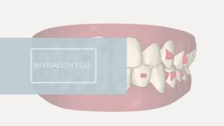 Invisalign Full ClinCheck  Invisalign casos difíciles [upl. by Haywood]