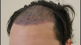 When Are Hair Transplant Grafts Safe [upl. by Assiruam933]