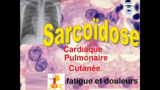 Sarcoidose pulmonaire articulaire renale hepatique cutanée ophtalmologique [upl. by Ettezel823]