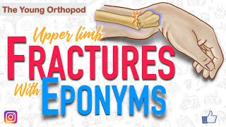 Named Fractures UPPER LIMB Fractures with EPONYMS NEET PG The Young Orthopod [upl. by Allx]