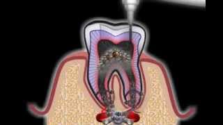 Wurzelbehandlung beim Zahnarzt [upl. by Hermon]