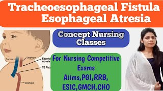 Tracheoesophageal Fistula and Esophageal Atresia pediatrics important topic [upl. by Kara393]