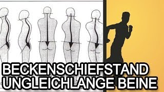 Beckenschiefstand und ungleichlange Beine  Ursache amp Symptome [upl. by Asnerek]