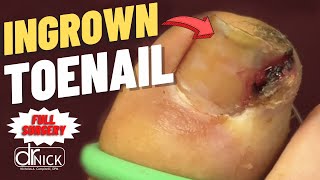 Extreme Closeup Ingrown Toenail Removal  Dr Nick Campitelli [upl. by Florry]