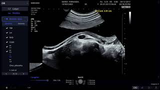Ecógrafo HS50 de SM Ecografía Obstétrica [upl. by Dilan61]
