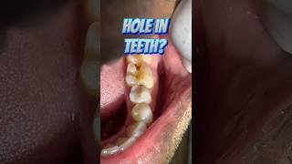 Hole in Teeth Treated with Indirect Restoration [upl. by Emile984]