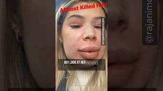 Dissolving Her Lip Fillers  Almost Fatal [upl. by Ferrand]