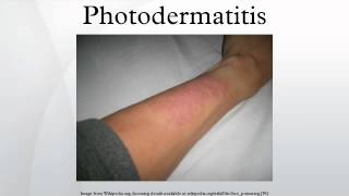 Photodermatitis [upl. by Amil]