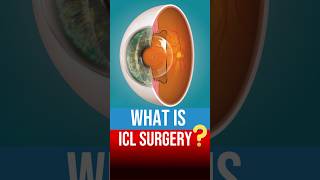 What Is ICL Surgery StepbyStep Guide to ICL Surgery [upl. by Alboran]