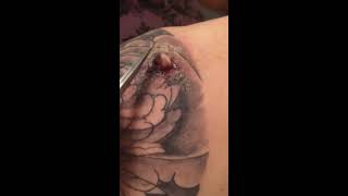 Infected abscess on tattoo [upl. by Oisangi]