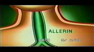 allerin philippines old tv commercial [upl. by Lebasy]