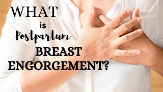 Postpartum Breast Engorgement information and tips for newborn breastfeeding [upl. by Irec380]