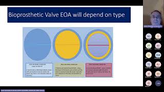 Prosthetic Heart Valve Assessment  Yorkshire regional valve teaching 17012024 [upl. by Archie]