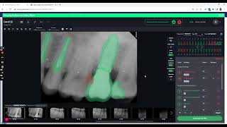 Dentrix Ascend Auto Charting Detect Denti AI [upl. by Marya]