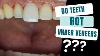 The Truth Behind Teeth Rot under Veneers [upl. by Giglio]