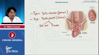 CIRUGÍA GENERAL Patología anorrectal Prolapso rectal mp4 [upl. by Norrahs568]