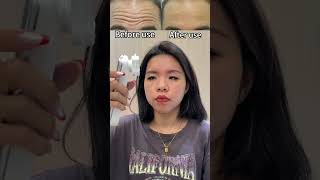 Reduce forehead wrinkles tips forehead wrinkles beautydevice beautyhacks beauty shorts [upl. by Homerus875]