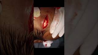 Lipoma removal under local anathesia from forehead [upl. by Nythsa]