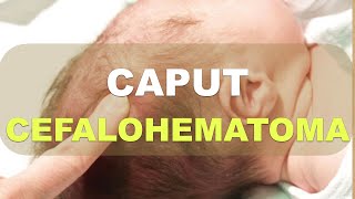 Caput Succedaneum Cefalohematoma Hemorragia Subgaleal Explicación [upl. by Llennhoj]