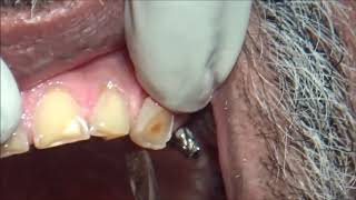 Attrited upper canine tooth removal with luxators and forceps [upl. by Ellennad432]