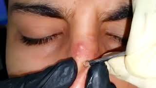 sac dep spa blackheads elderly 2024  sac dep spa old age blackheads 2024  sac dep spa thuy today [upl. by Cappello314]