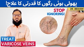 Varicose Veins Ka Qudrati Ilaj  Treat Varicose Spider Veins Naturally  UrduHindi  Dr Ibrahim [upl. by Oringas]