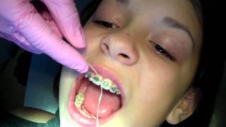 How to floss with braces by Orthodontist in Rogers AR [upl. by Harlamert]