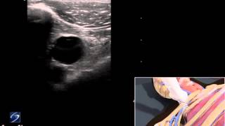 3D How To Ultrasound Guided Insertion of a Subclavian Vein Catheter  SonoSite Ultrasound [upl. by Anelad]