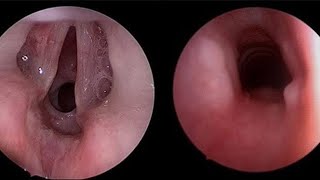 Pediatric Congenital Subglottic Stenosis [upl. by Doolittle]