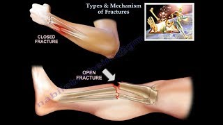 Fracture Healing  ANIMATION  BASICS  The Young Orthopod [upl. by Rahs915]