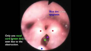 Laryngomalacia  The Floppy Airway [upl. by Landrum]