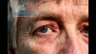 Xanthelasma Removal without TCA [upl. by Airdnala712]