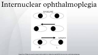 Internuclear ophthalmoplegia [upl. by Icart]