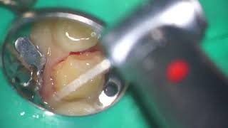 Treatment of upper 2nd primary molar with NuSmile ZR crown [upl. by Aihsetal]