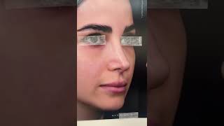 Reconstructive nose surgery with Dr Bashartizadeh جراحی ترمیمی بینی با دکتر بشارتی زاده [upl. by Faubion]