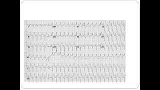 Fascicular VT  Dr Akif Baig [upl. by Veta4]