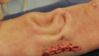 Ear grows on cancer patients arm for surgery [upl. by Fred]