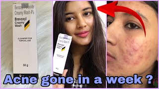 Brevoxyl Cream FaceWash for Rs 139 Review  Benzoyl Peroxide Creamy Wash Review  Somi Singh [upl. by Margalit664]