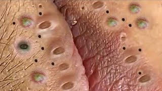 Big Cystic Acne Blackheads Extraction Blackheads amp Milia Whiteheads Removal Pimple Popping  8990 [upl. by Ttirb73]