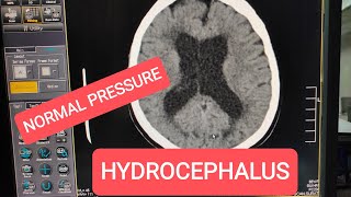 Normal Pressure Hydrocephalus CT Scan Brain [upl. by Zinnes]