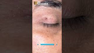 WART REMOVAL Magical Result by DR LALIT KASANA [upl. by Rafter455]