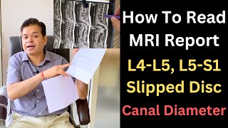 Lower Back MRI L4 L5 Herniated Disc MRI Stenosis of the Spine How to know Lumbar canal Diameter [upl. by Amaj]