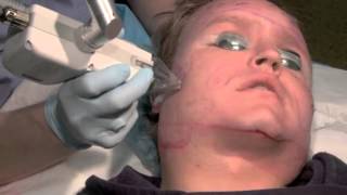 Fraxel Laser Subcision Acne Scar Treatment [upl. by Awram]