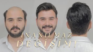 PROTEZ SAÇ İLE İNANILMAZ DEĞİŞİM  Hair Replacement [upl. by Rockey]