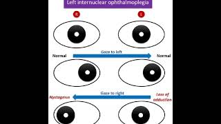 INTERNUCLEAR OPHTHALMOPLEGIA [upl. by Yrellav311]