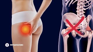 Pain in the butt  Its NOT Piriformis Syndrome [upl. by Vharat]