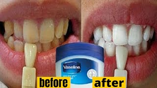 Blanchiment des dents à utiliser de la vaseline pour transformer les dents sales en blanc brillant [upl. by Legir]